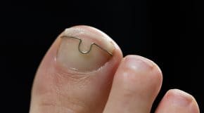 orthoplastie